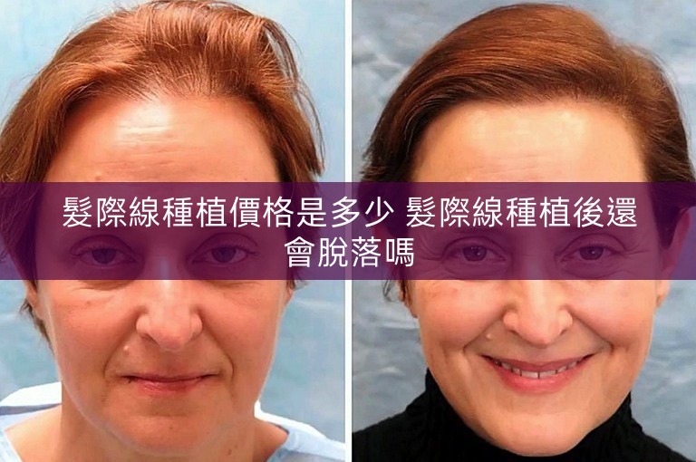 髮際線種植價格是多少 髮際線種植後還會脫落嗎