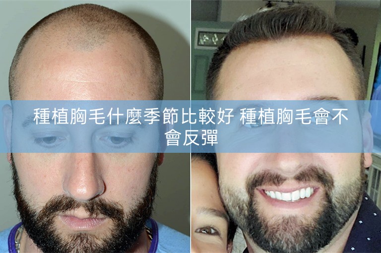 種植胸毛什麼季節比較好 種植胸毛會不會反彈 種植胸毛什麼季節比較好 種植胸毛會不會反彈