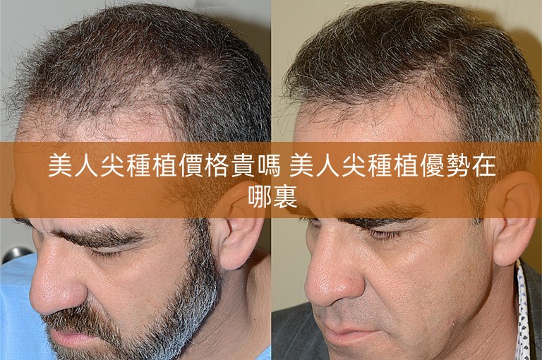 美人尖種植價格貴嗎 美人尖種植優勢在哪裏