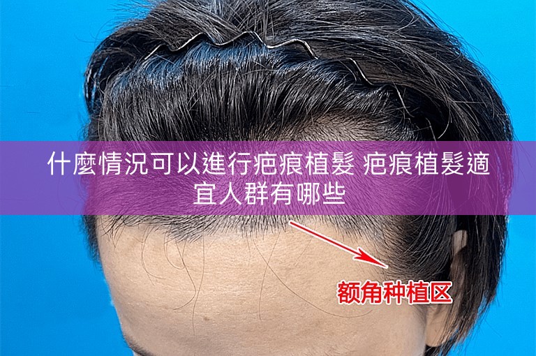 什麼情況可以進行疤痕植髮 疤痕植髮適宜人群有哪些