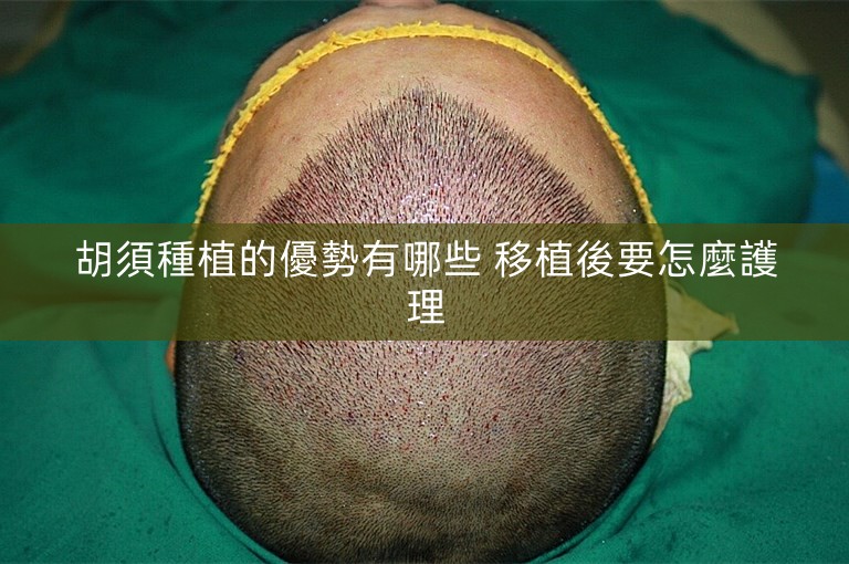 胡須種植的優勢有哪些 移植後要怎麼護理 胡須種植的優勢有哪些 移植後要怎麼護理