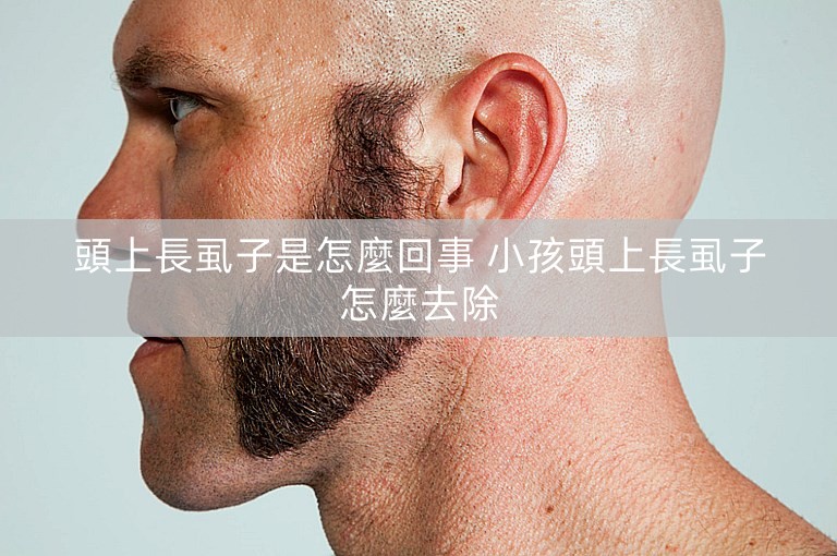 頭上長虱子是怎麼回事 小孩頭上長虱子怎麼去除 頭上長虱子是怎麼回事 小孩頭上長虱子怎麼去除