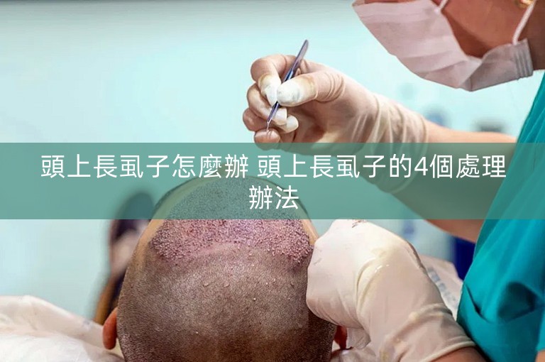 頭上長虱子怎麼辦 頭上長虱子的4個處理辦法 頭上長虱子怎麼辦 頭上長虱子的4個處理辦法