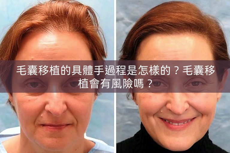 毛囊移植的具體手過程是怎樣的？毛囊移植會有風險嗎？