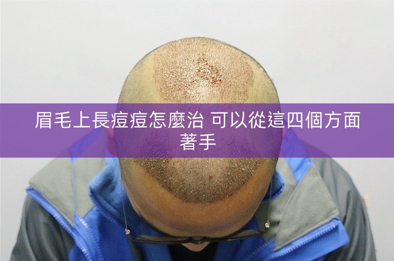 眉毛上長痘痘怎麼治 可以從這四個方面著手