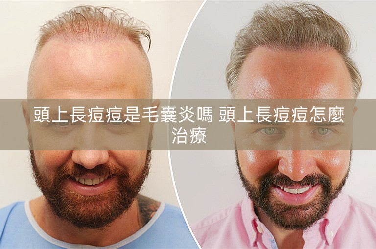 頭上長痘痘是毛囊炎嗎 頭上長痘痘怎麼治療 頭上長痘痘是毛囊炎嗎 頭上長痘痘怎麼治療