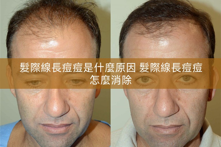 髮際線長痘痘是什麼原因 髮際線長痘痘怎麼消除 髮際線長痘痘是什麼原因 髮際線長痘痘怎麼消除