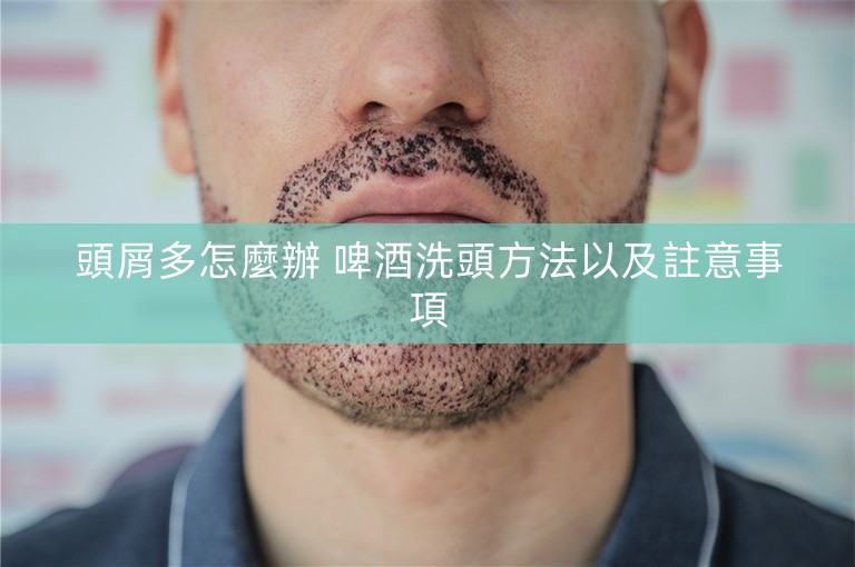 頭屑多怎麼辦 啤酒洗頭方法以及註意事項