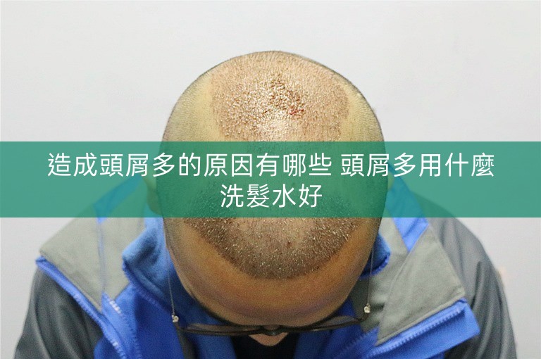 造成頭屑多的原因有哪些 頭屑多用什麼洗髮水好 造成頭屑多的原因有哪些 頭屑多用什麼洗髮水好