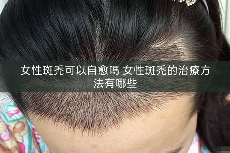 女性斑禿可以自愈嗎 女性斑禿的治療方法有哪些