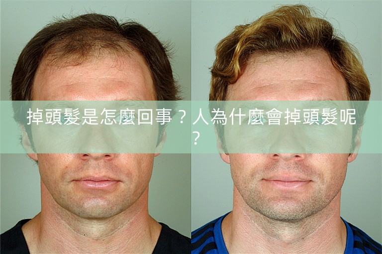 掉頭髮是怎麼回事?人為什麼會掉頭髮呢? 掉頭髮是怎麼回事?人為什麼會掉頭髮呢?