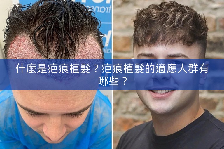 什麼是疤痕植髮?疤痕植髮的適應人群有哪些? 什麼是疤痕植髮?疤痕植髮的適應人群有哪些?