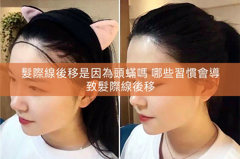 髮際線後移是因為頭蟎嗎 哪些習慣會導致髮際線後移