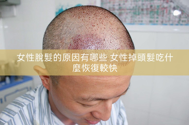 女性脫髮的原因有哪些 女性掉頭髮吃什麼恢復較快