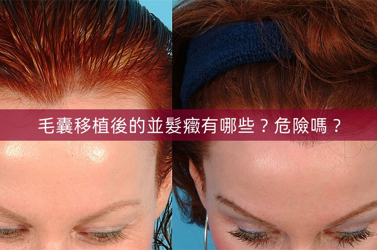 毛囊移植後的並髮癥有哪些?危險嗎? 毛囊移植後的並髮癥有哪些?危險嗎?