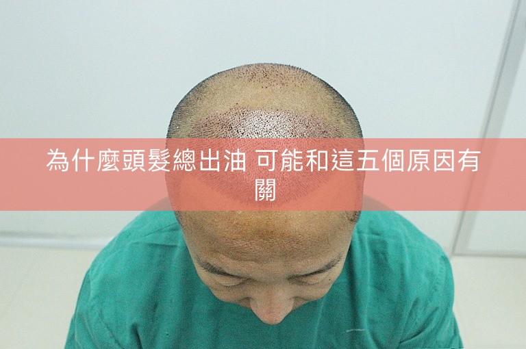 為什麼頭髮總出油 可能和這五個原因有關