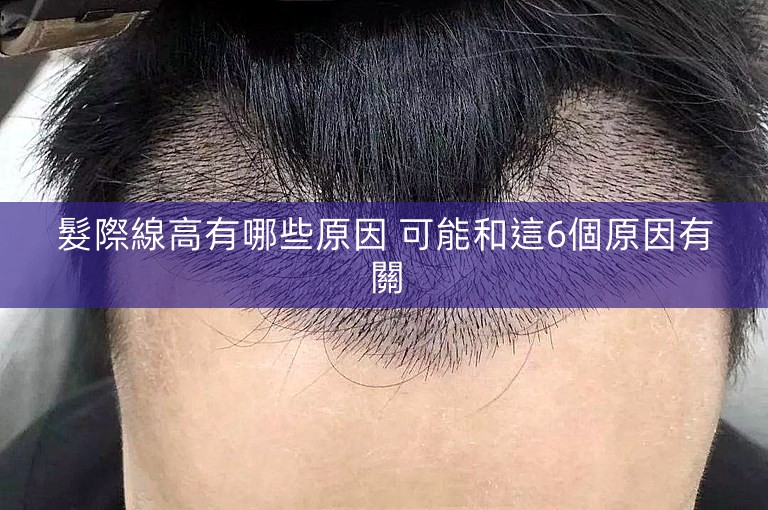 髮際線高有哪些原因 可能和這6個原因有關 髮際線高有哪些原因 可能和這6個原因有關