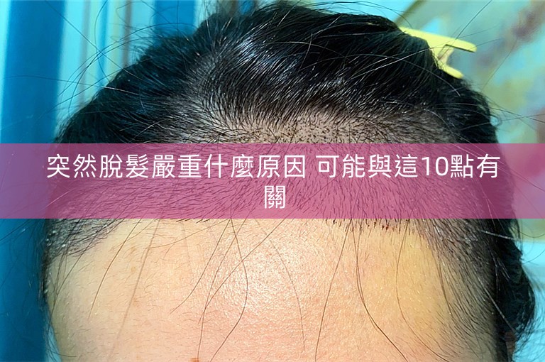 突然脫髮嚴重什麼原因 可能與這10點有關