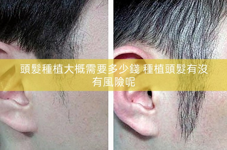頭髮種植大概需要多少錢 種植頭髮有沒有風險呢