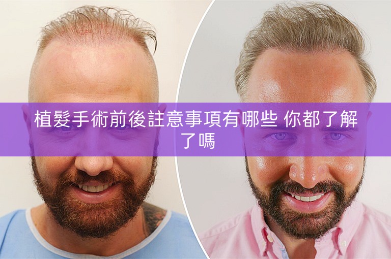 植髮手術前後註意事項有哪些 你都了解了嗎 植髮手術前後註意事項有哪些 你都了解了嗎