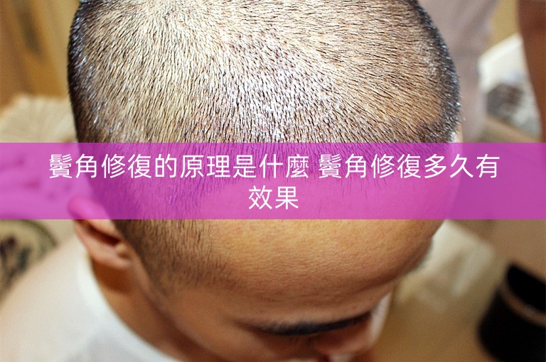鬢角修復的原理是什麼 鬢角修復多久有效果
