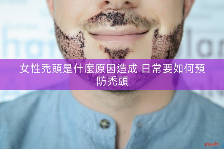 女性禿頭是什麼原因造成 日常要如何預防禿頭