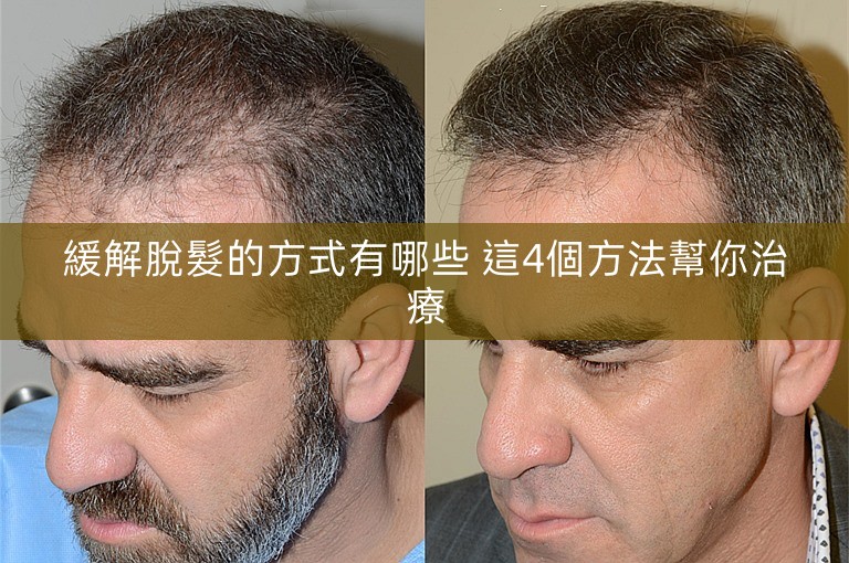 緩解脫髮的方式有哪些 這4個方法幫你治療