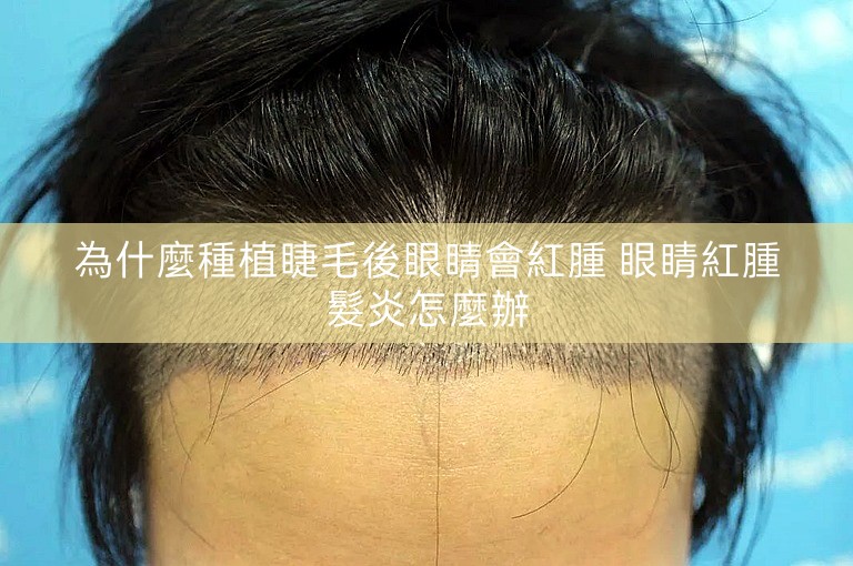 為什麼種植睫毛後眼睛會紅腫 眼睛紅腫髮炎怎麼辦