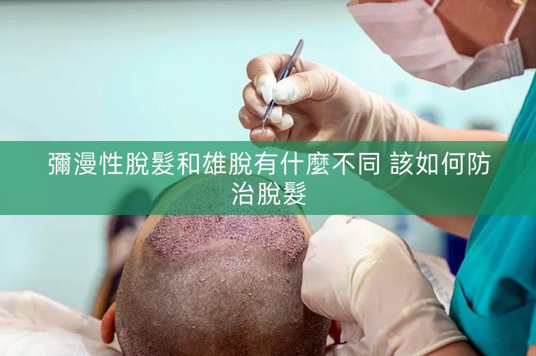 彌漫性脫髮和雄脫有什麼不同 該如何防治脫髮