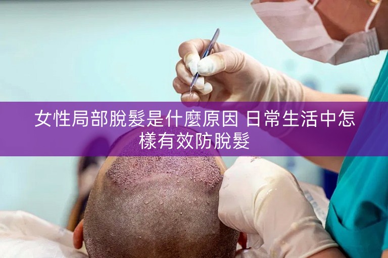女性局部脫髮是什麼原因 日常生活中怎樣有效防脫髮