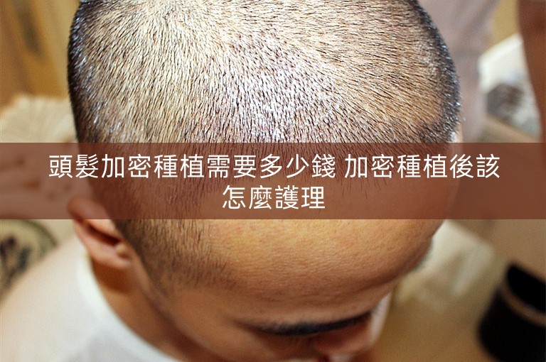 頭髮加密種植需要多少錢 加密種植後該怎麼護理