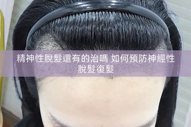 精神性脫髮還有的治嗎 如何預防神經性脫髮復髮