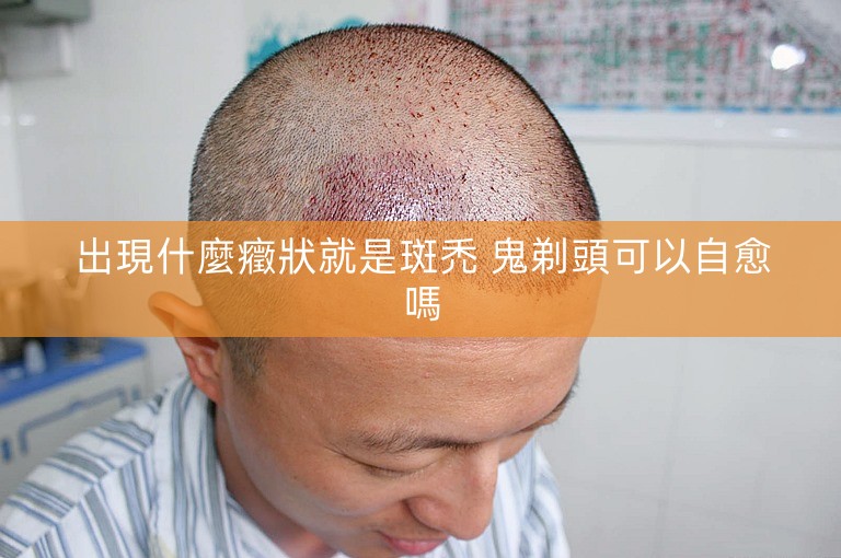 出現什麼癥狀就是斑禿 鬼剃頭可以自愈嗎