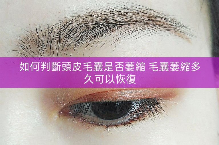 如何判斷頭皮毛囊是否萎縮 毛囊萎縮多久可以恢復