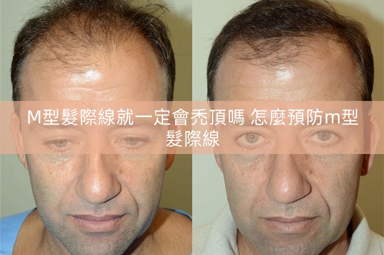 M型髮際線就一定會禿頂嗎 怎麼預防m型髮際線