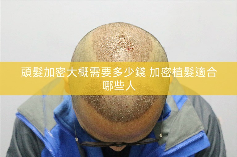 頭髮加密大概需要多少錢 加密植髮適合哪些人