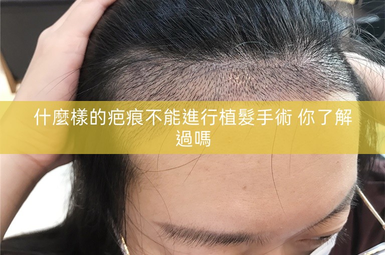 什麼樣的疤痕不能進行植髮手術 你了解過嗎