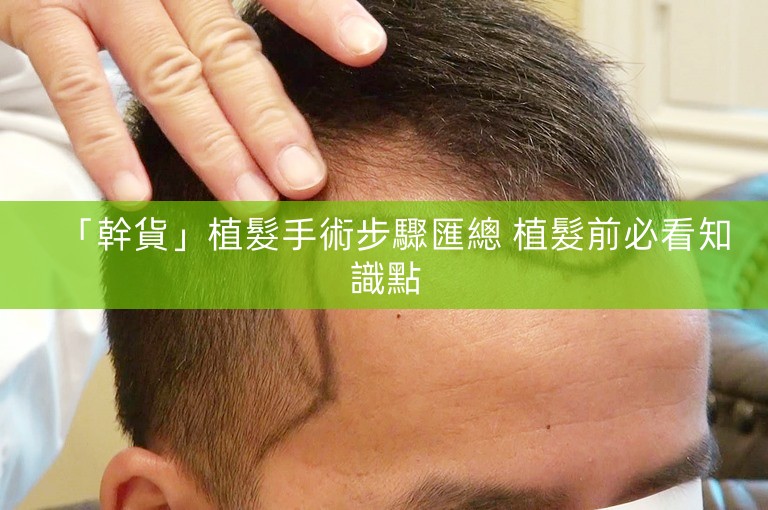 「幹貨」植髮手術步驟匯總 植髮前必看知識點 「幹貨」植髮手術步驟匯總 植髮前必看知識點