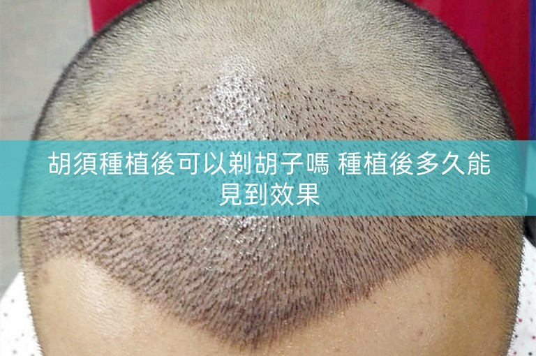 胡須種植後可以剃胡子嗎 種植後多久能見到效果