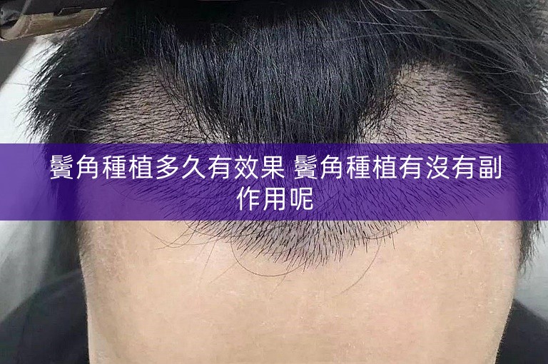 鬢角種植多久有效果 鬢角種植有沒有副作用呢