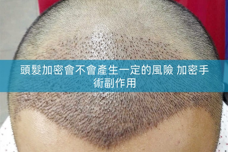 頭髮加密會不會產生一定的風險 加密手術副作用