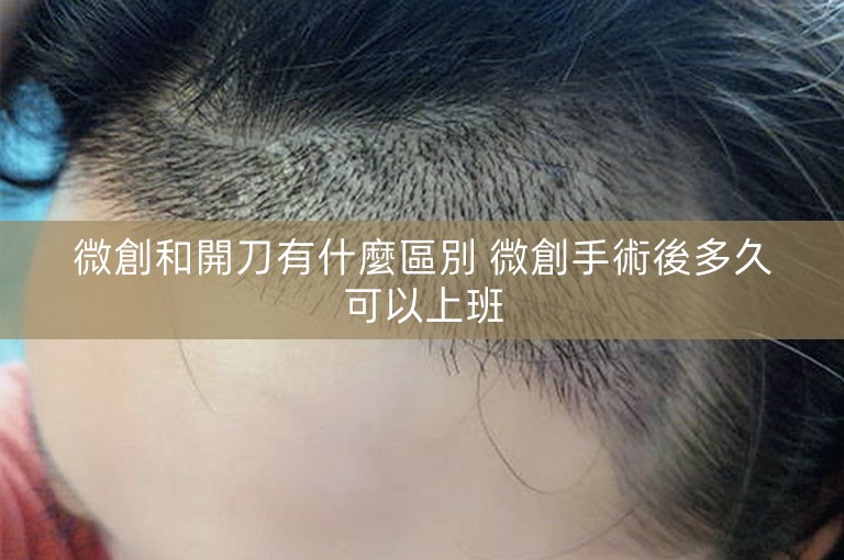 微創和開刀有什麼區別 微創手術後多久可以上班