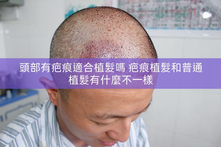 頭部有疤痕適合植髮嗎 疤痕植髮和普通植髮有什麼不一樣