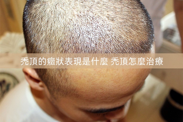禿頂的癥狀表現是什麼 禿頂怎麼治療