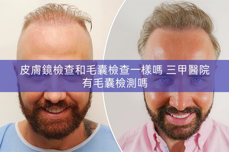 皮膚鏡檢查和毛囊檢查一樣嗎 三甲醫院有毛囊檢測嗎