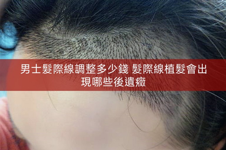 男士髮際線調整多少錢 髮際線植髮會出現哪些後遺癥