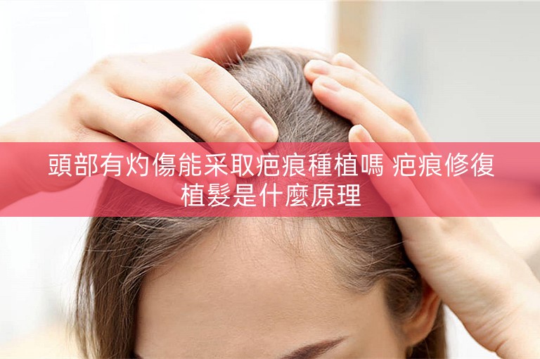 頭部有灼傷能采取疤痕種植嗎 疤痕修復植髮是什麼原理 頭部有灼傷能采取疤痕種植嗎 疤痕修復植髮是什麼原理