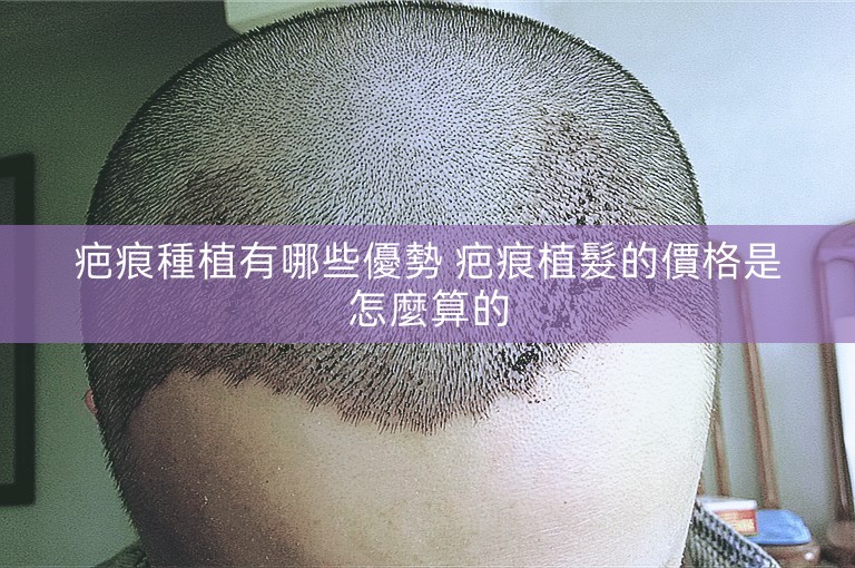 疤痕種植有哪些優勢 疤痕植髮的價格是怎麼算的