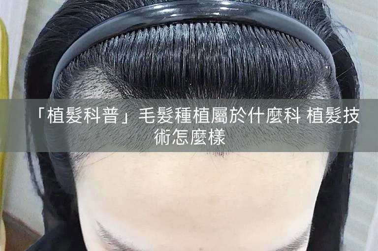 「植髮科普」毛髮種植屬於什麼科 植髮技術怎麼樣