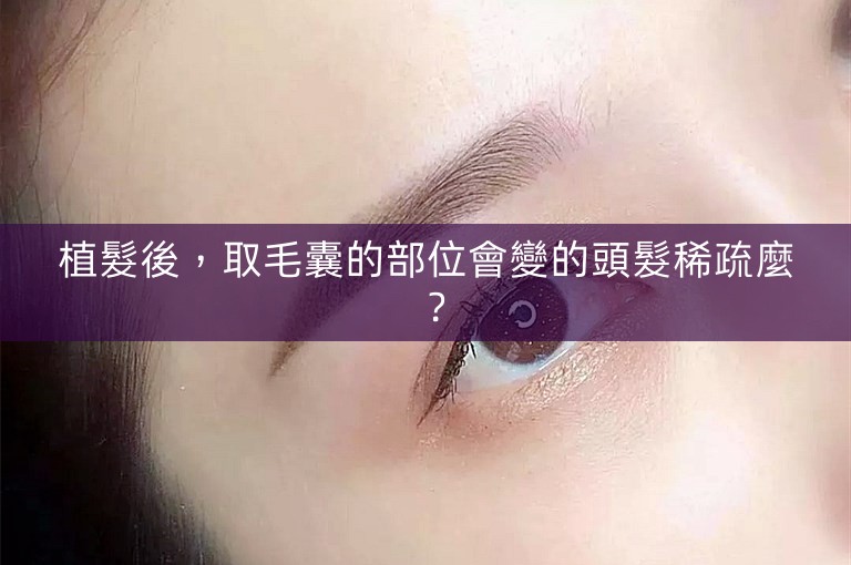 植髮後,取毛囊的部位會變的頭髮稀疏麼? 植髮後,取毛囊的部位會變的頭髮稀疏麼?